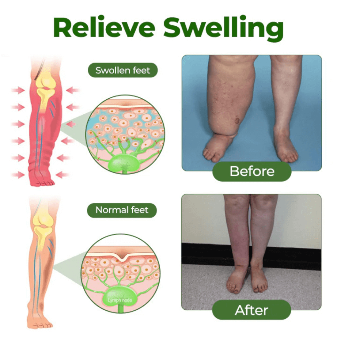 Relieflogix Edema Relief Lotion